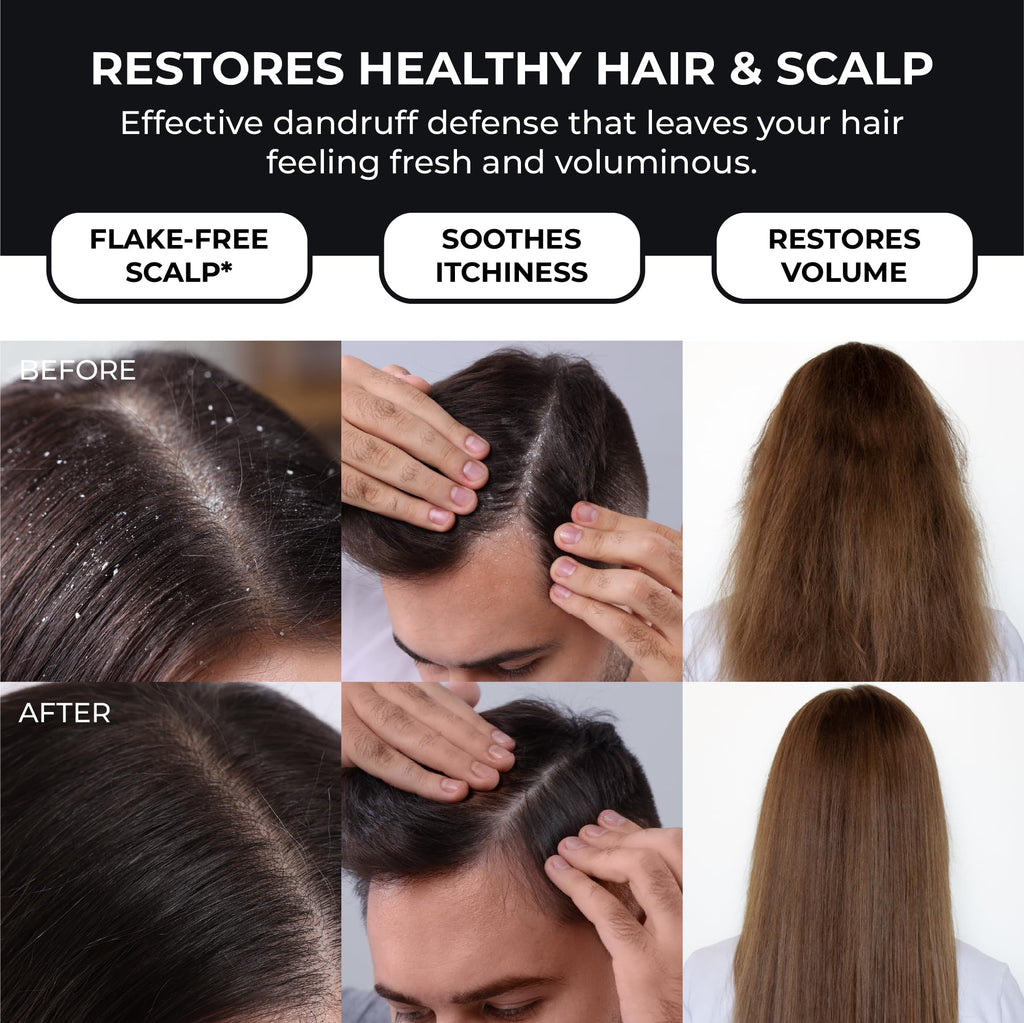 ABERA Anti-Dandruff Shampoo – Stronger Hair & Healthier Scalp (6.67 fl oz)
