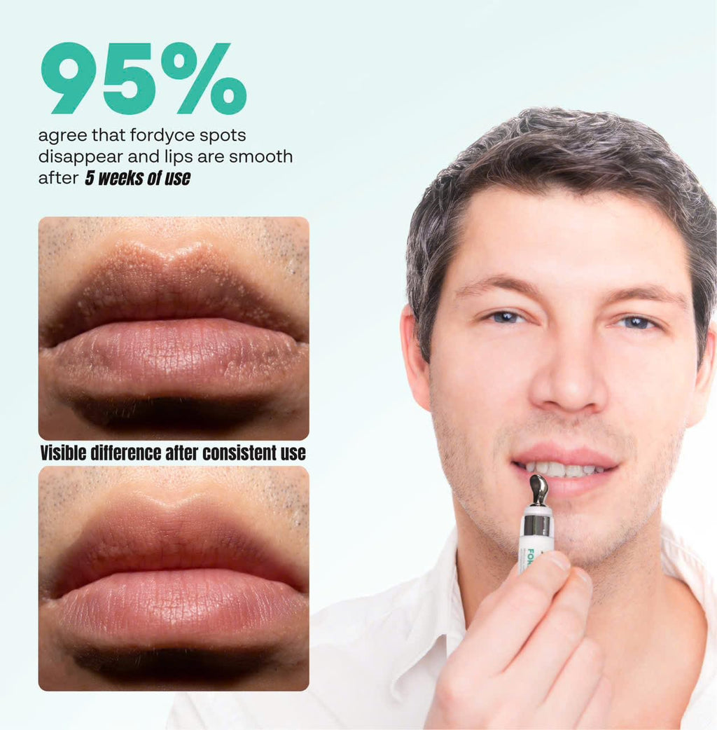 ABERA Fordyce Cream – Advanced HPR Formula for Lips | Fordyce Spot Remover & All-Day Moisturizing (0.7 oz)