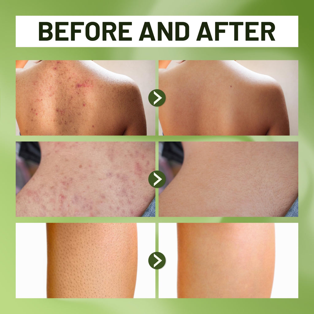 ABERA Folliculitis Body Wash with Wild Bitter Melon & Tea Tree – 10.14 oz