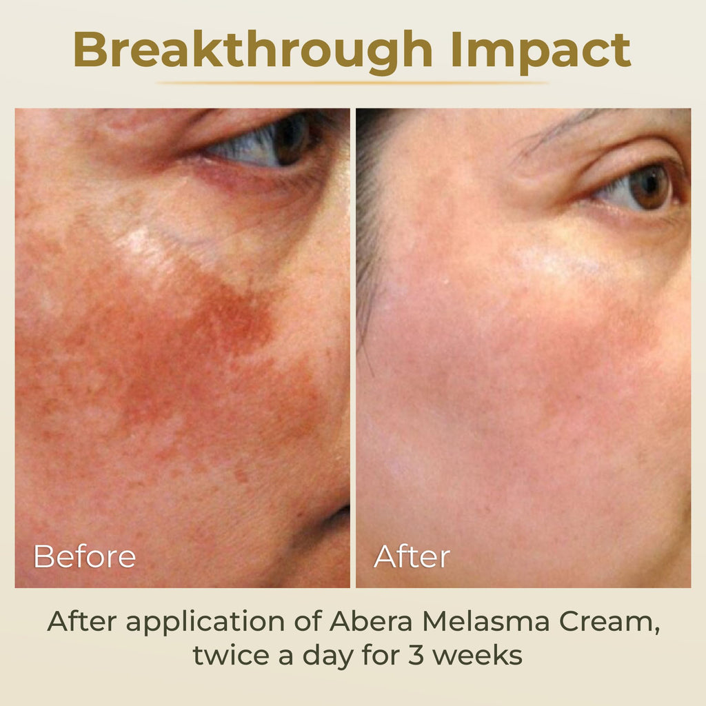 ABERA Melasma Cream - Dark Spot Corrector (0.7 oz) for Freckles, Sun Spots & Melasma