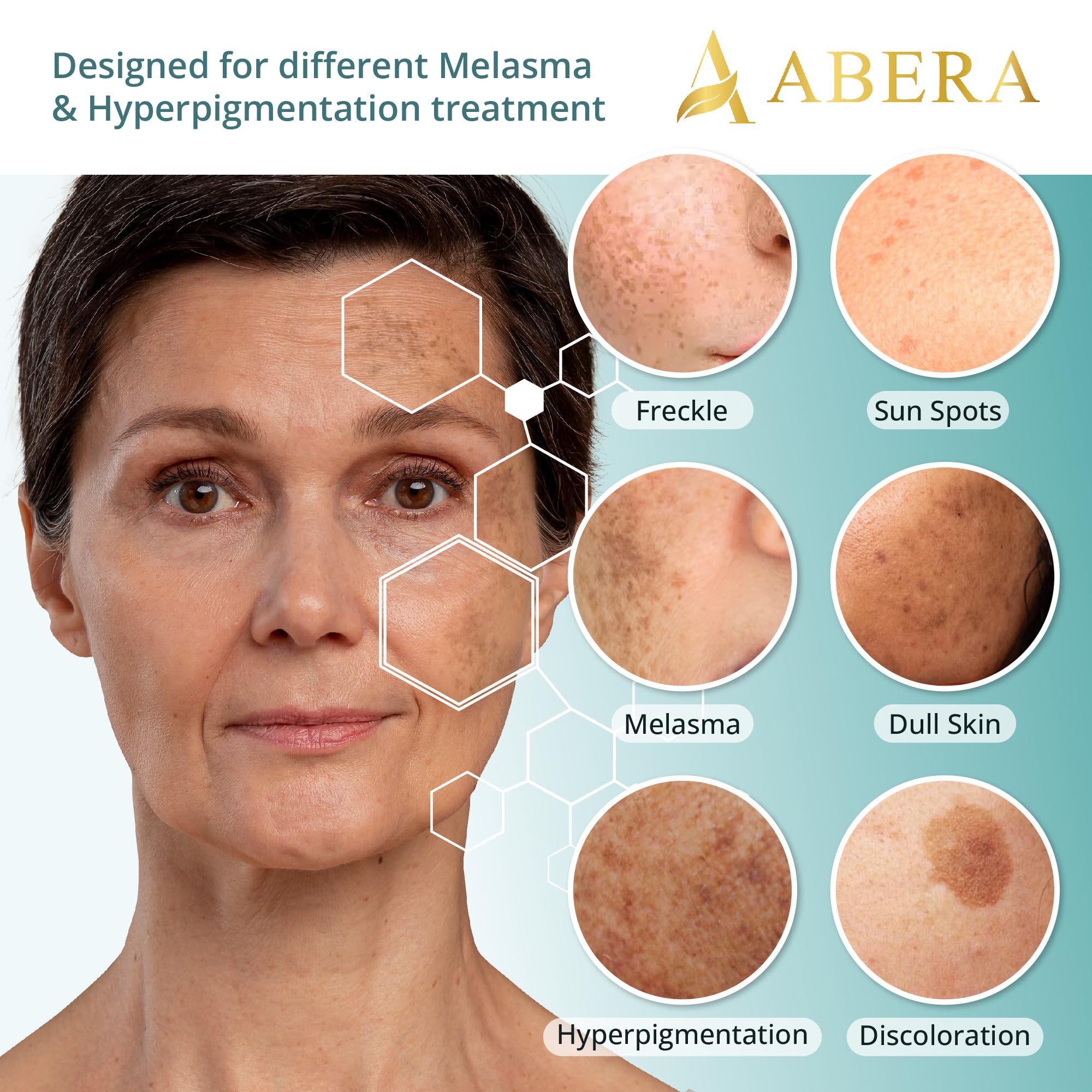 ABERA Melasma Serum Plus – Melasma Treatment for Face, Dark Spot Remover, All Skin Tones (1 FL OZ)