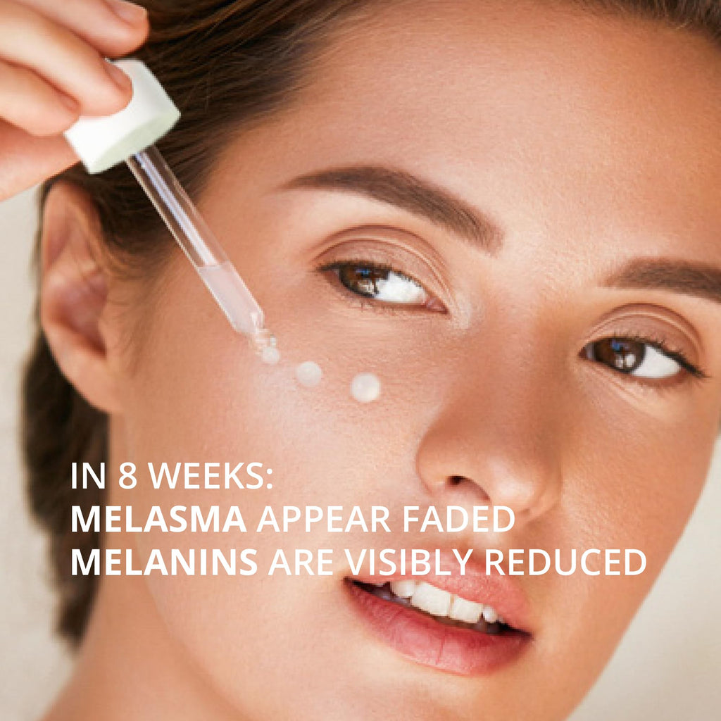 ABERA Melasma Serum Plus – Melasma Treatment for Face, Dark Spot Remover, All Skin Tones (1 FL OZ)