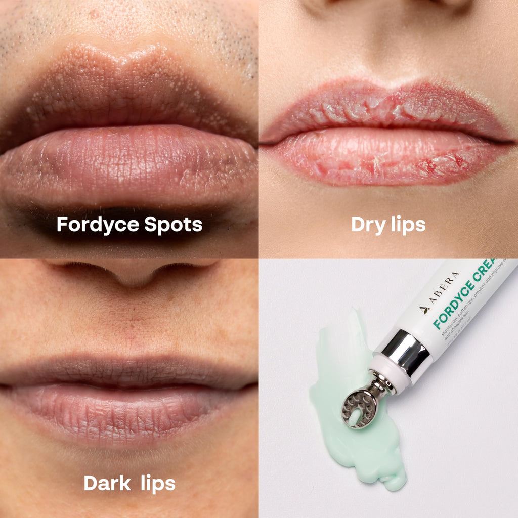 ABERA Fordyce Cream – Advanced HPR Formula for Lips | Fordyce Spot Remover & All-Day Moisturizing (0.7 oz)