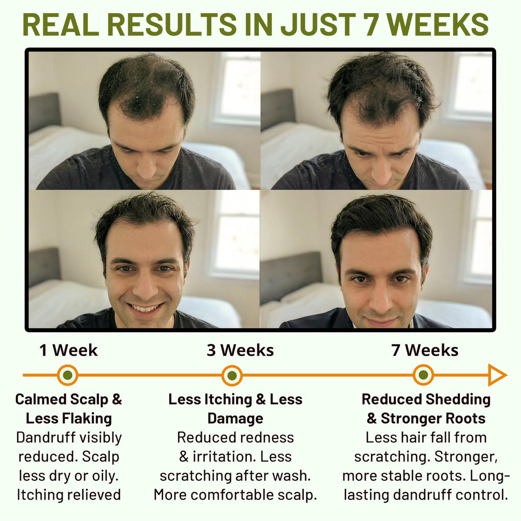 ABERA High-Performance Anti-Dandruff Shampoo – Langbian Ginseng, Sulfate & Paraben Free, Deep Cleansing (5.07 Fl Oz)