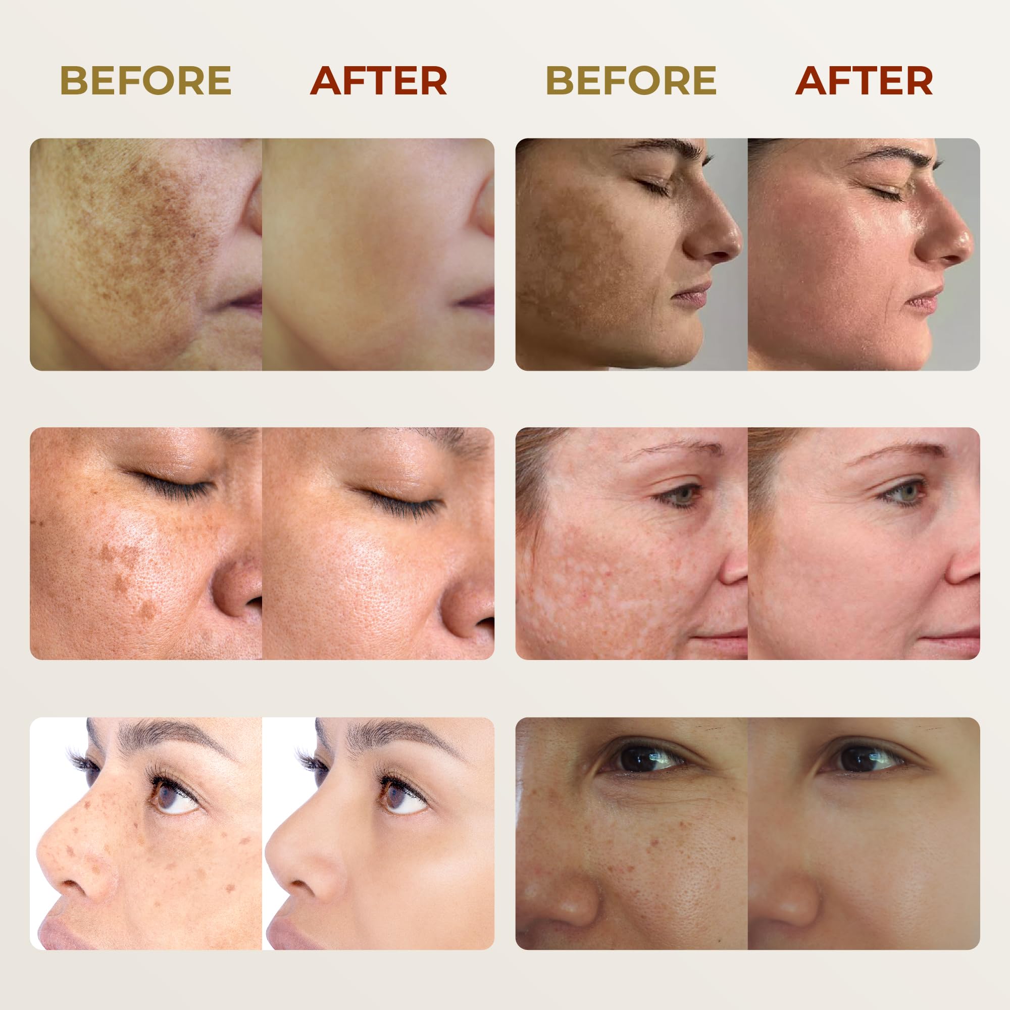 ABERA Melasma Cream - Dark Spot Corrector (0.7 oz) for Freckles, Sun Spots & Melasma