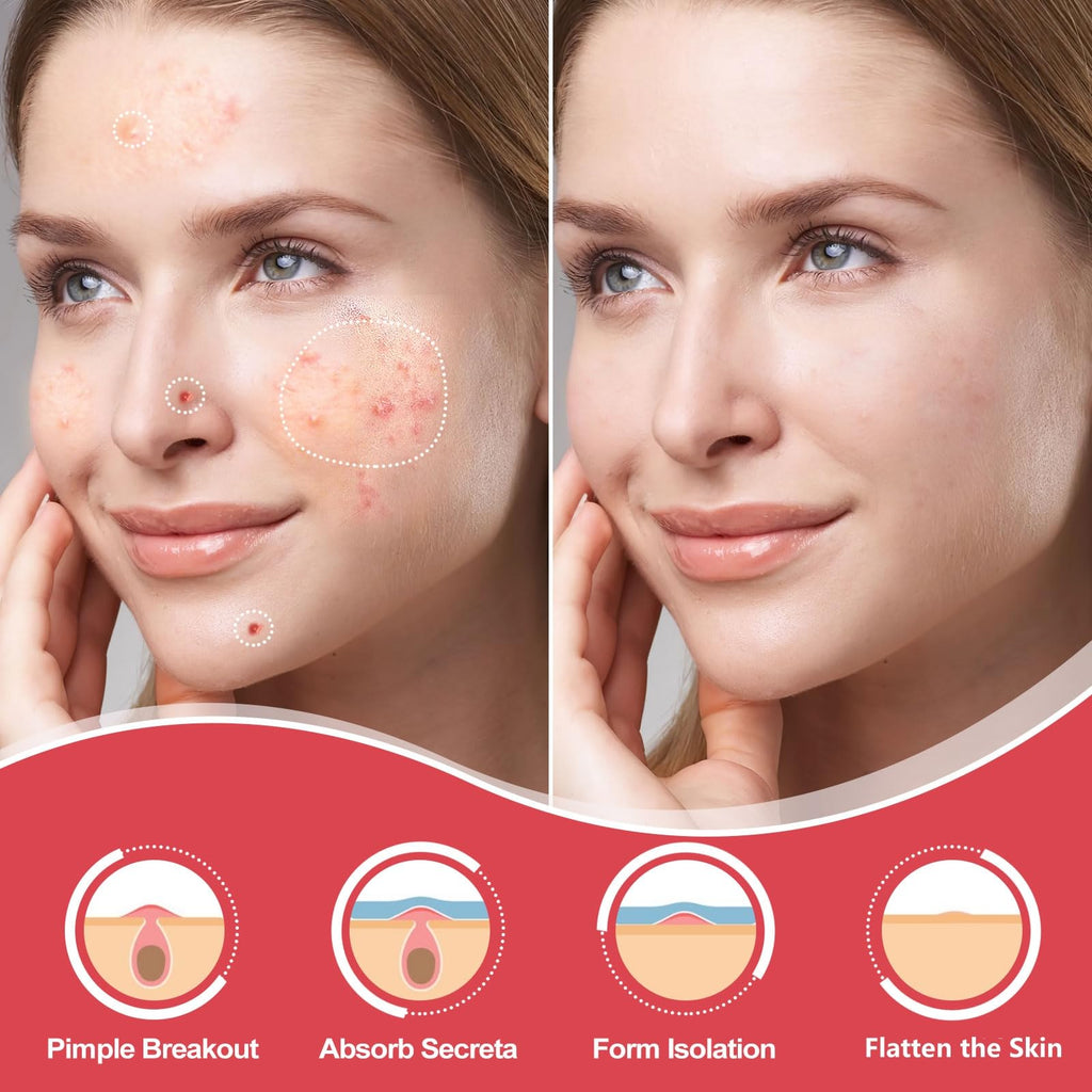 AcneGo 432 Counts Pimple Patches – Invisible Hydrocolloid Patches for All Skin Types