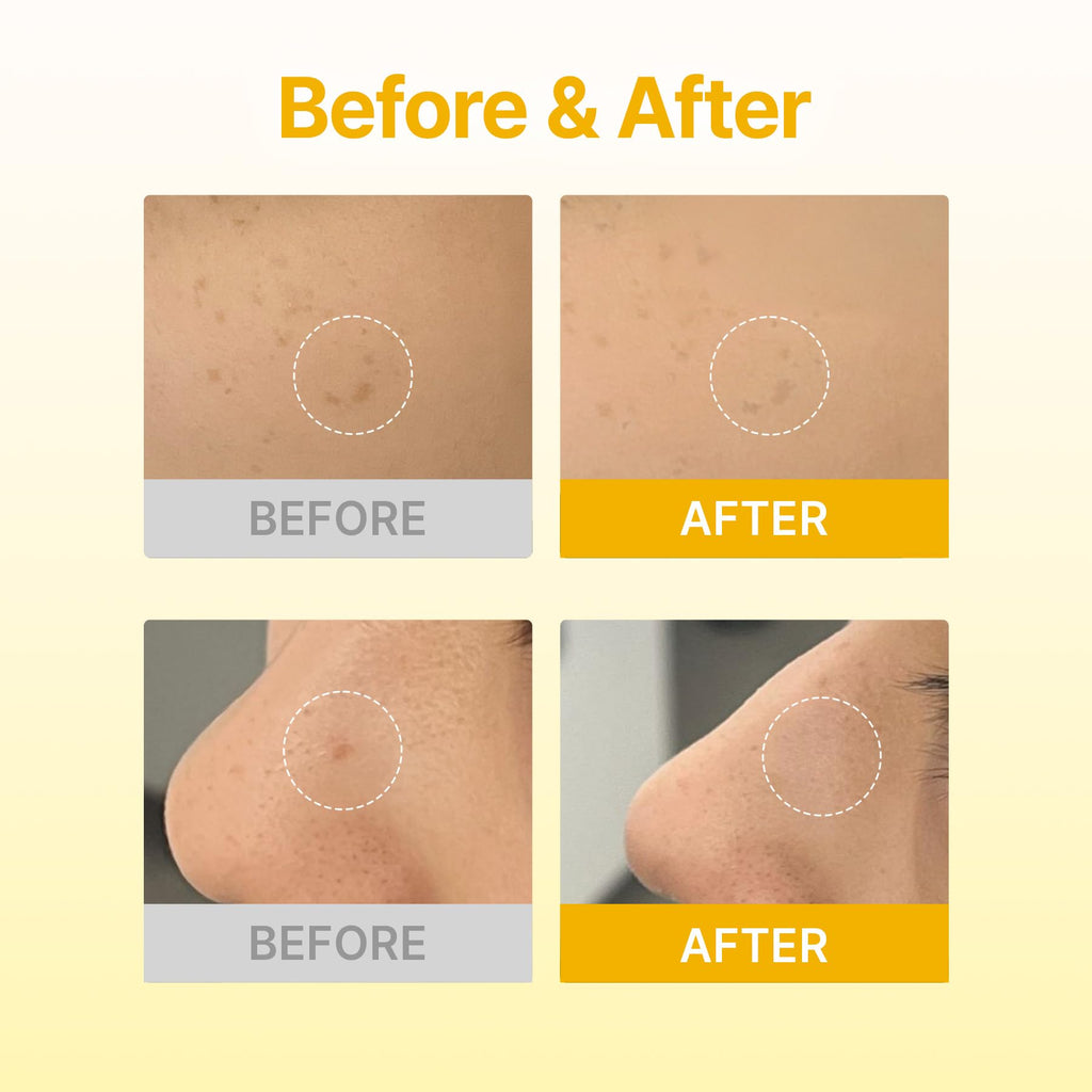 Acropass Dark Spot Microcone Patch – Brightening for Post-Blemish Marks with Vitamin C & Niacinamide