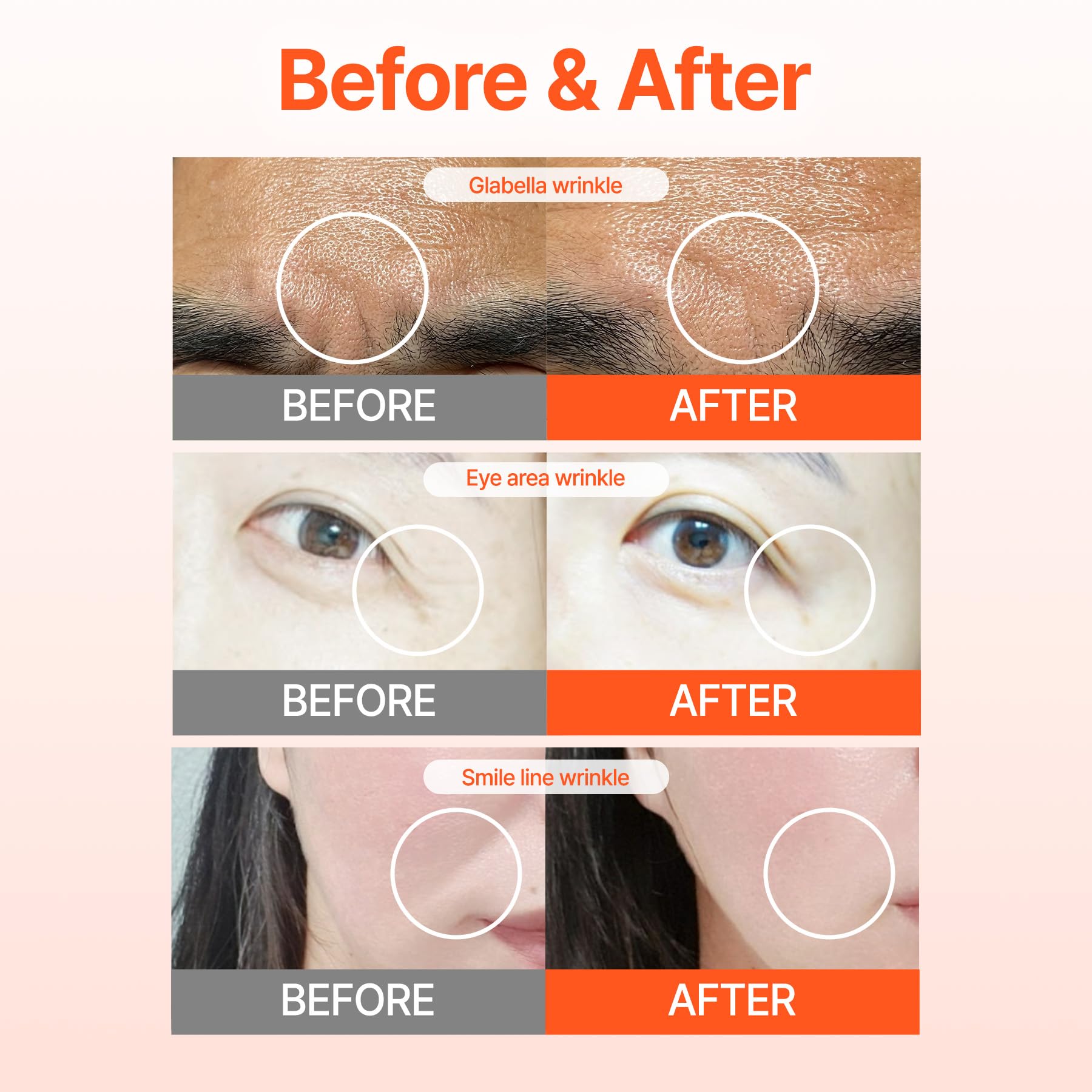 Acropass RETI-RN Microcone Patches | Deep Wrinkles, PDRN 10,000 ppm, Retinol 3,300 IU/g, Hyaluronic Acid – Slim Type (6 Count)