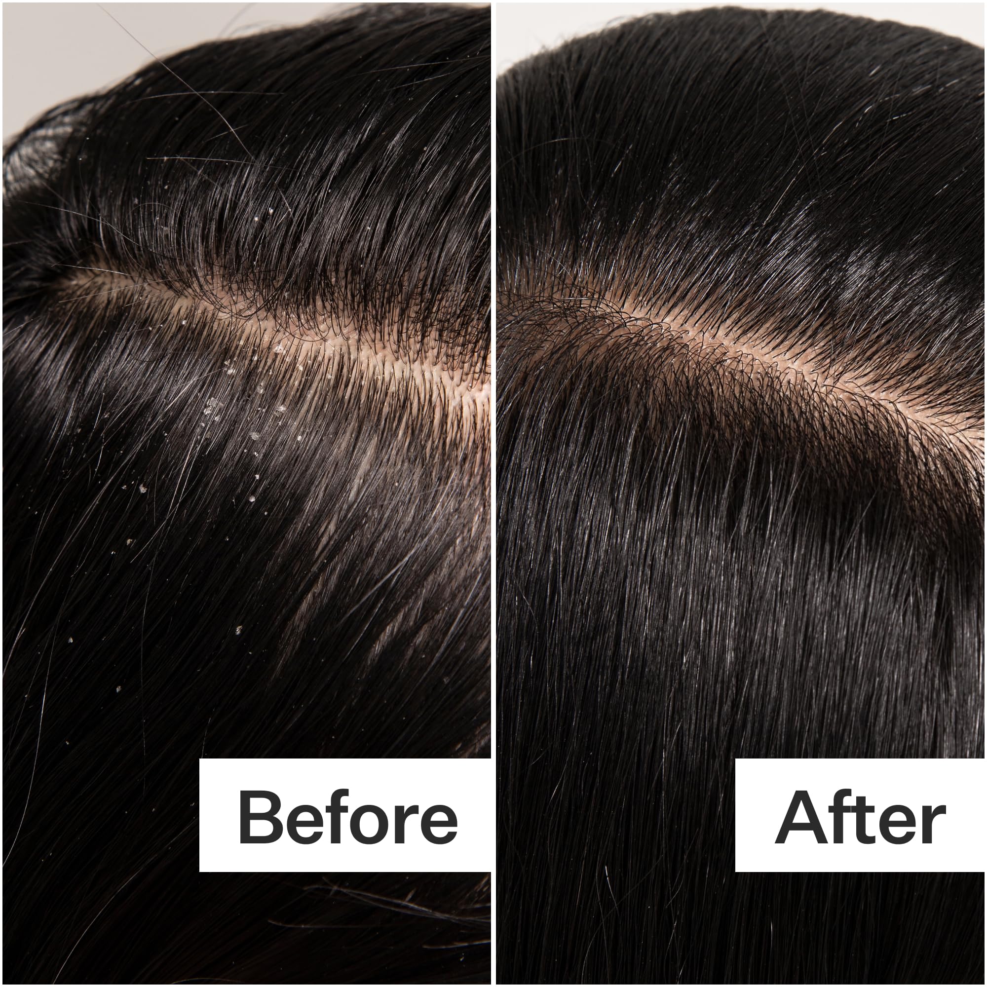 ACT+ ACRE Cold Processed Scalp Detox Oil — Sulfate-Free Scalp Care for Flaky, Dry & Itchy Scalp