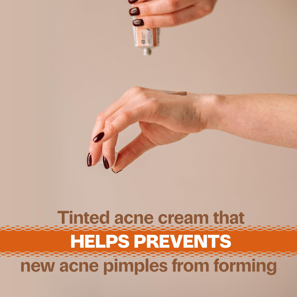 Adult Acnomel Acne Medication Cream, 1.3 Ounces – Gentle, Benzoyl Peroxide Free