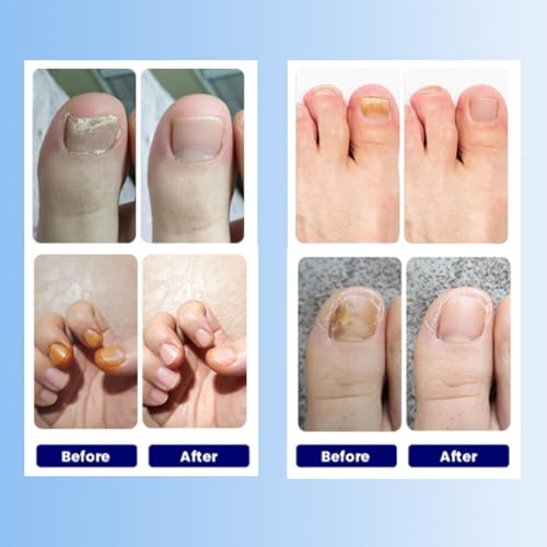 Aedydyce Toenail Fungus Treatment Extra Strength – 42 Patches (Two Packs of 21)