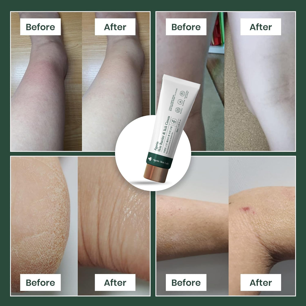 AGERIN Anti-Itch Cream – Hydrating Skin Barrier & Itch Relief (Vegan)