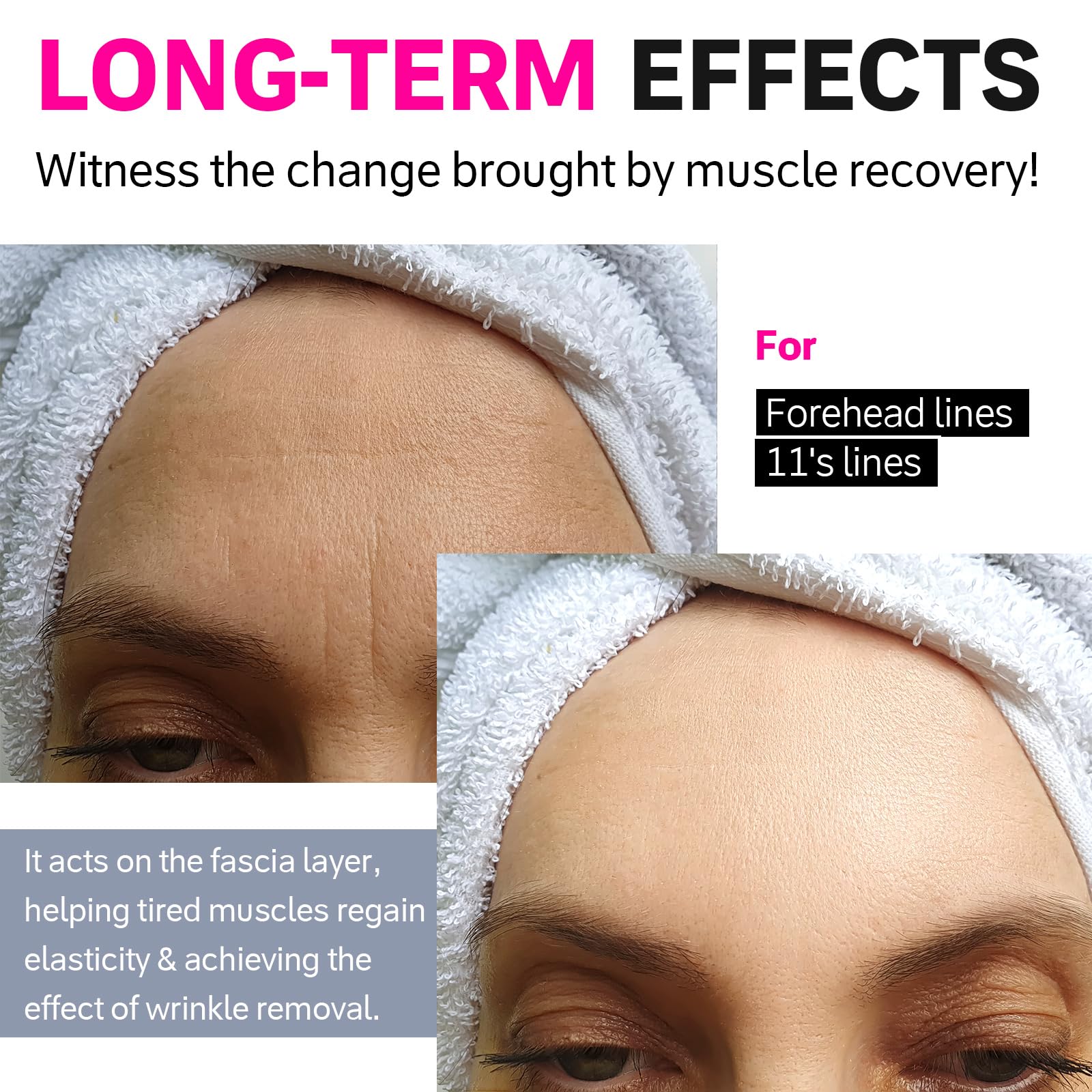 Akissos Wrinkle Patches – Precut Forehead Tape for 11 Lines & Frown Lines (30 PCS)