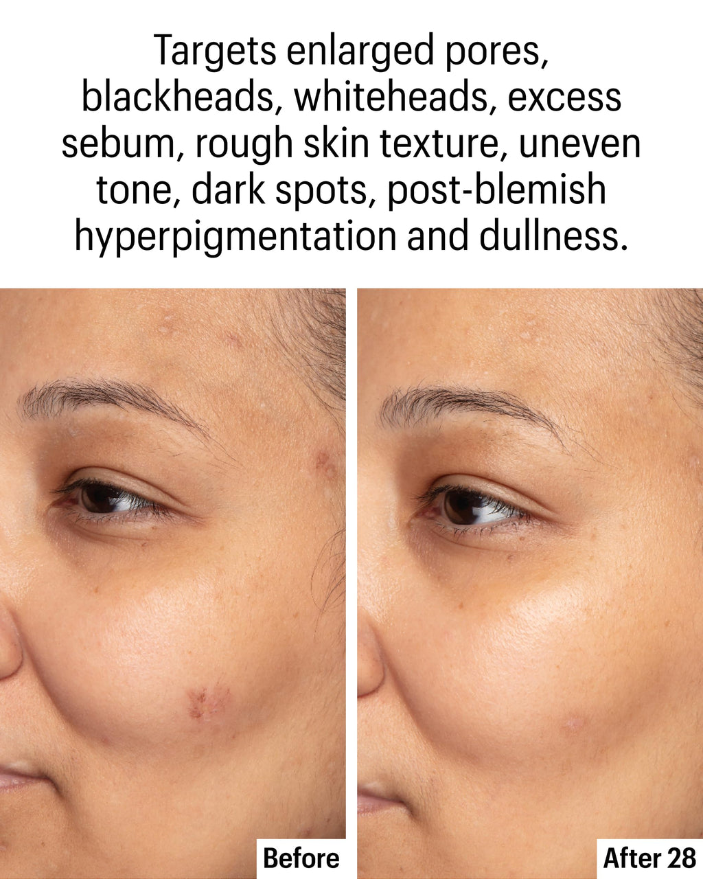 Allies of Skin Azelaic & Kojic Clarifying Serum | 10% Azelaic for Clearer Skin (1 oz)