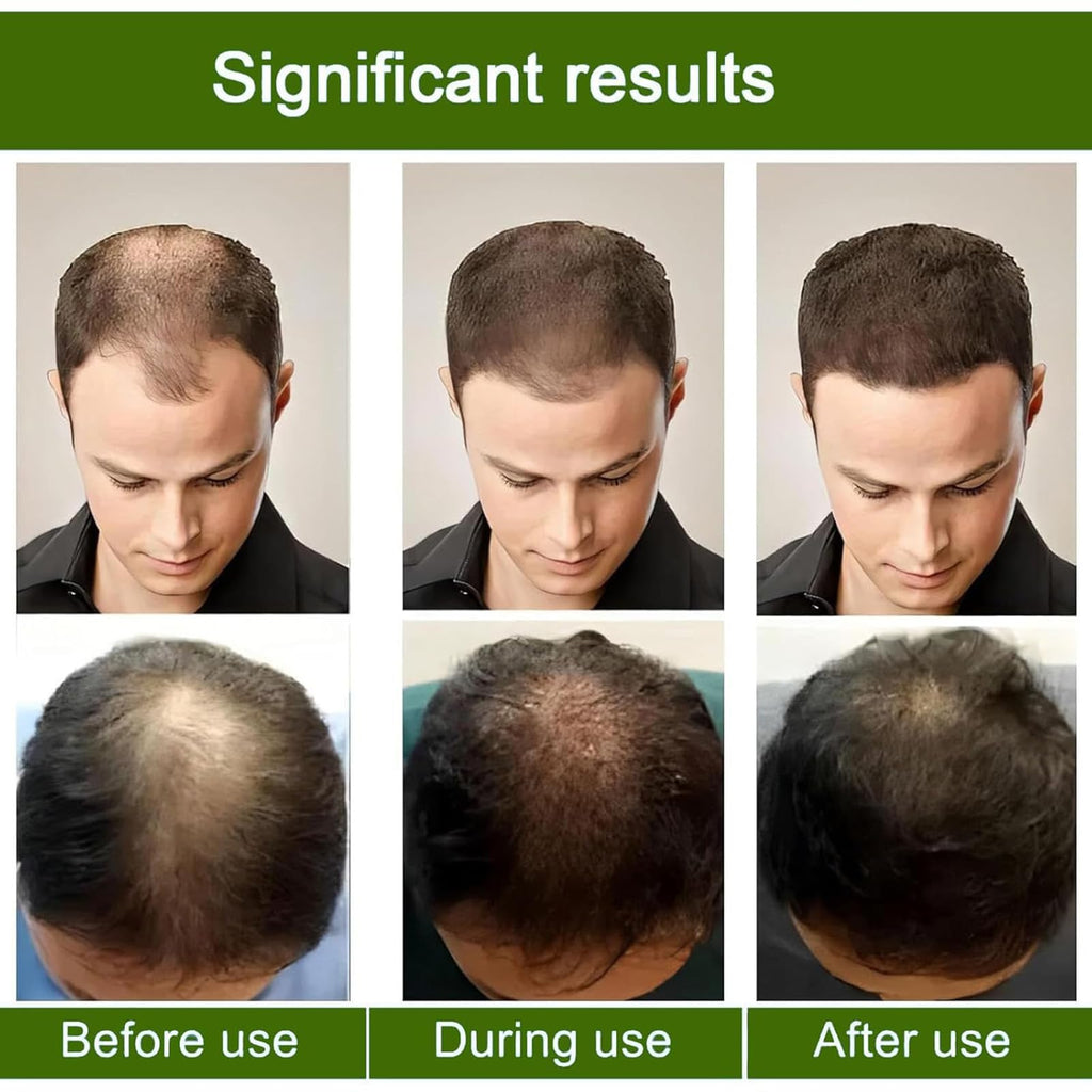 AlphainFuze Hair Regrowth System – Advanced Growth Treatment