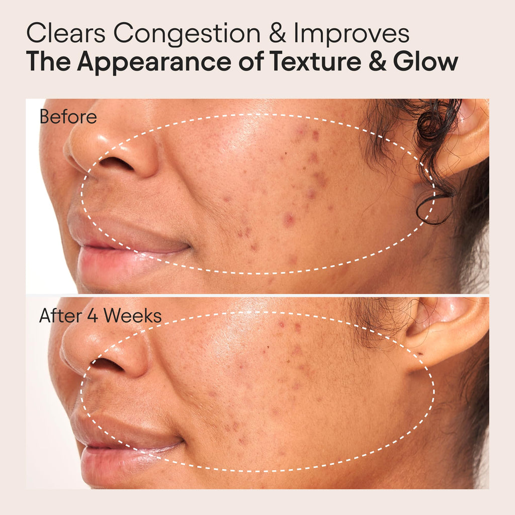 ALPYN Clarifying Facial Oil with Retinol & Pink Algae | Clear Congestion & Glow