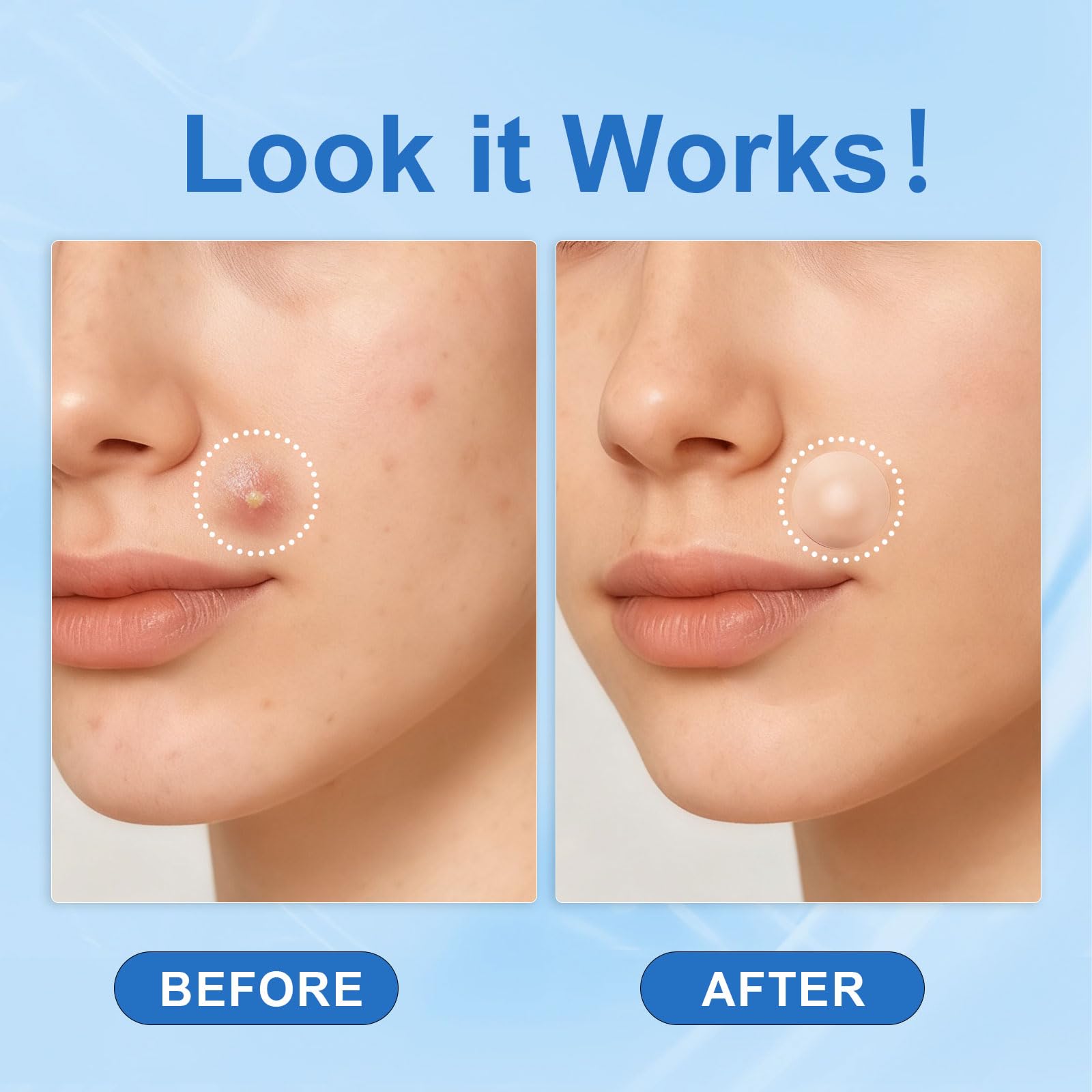 Amouy Acne Pimple Patch – 2 Sizes, 612 Dots Hydrocolloid Patches with Witch Hazel, Tea Tree & Calendula