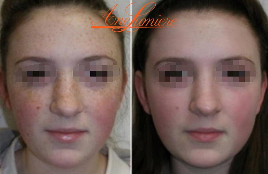 Ane Lumiere Miami Jessner Complex Peel – Exfoliating Facial Peel for Even Tone & Radiance (1.7 oz)