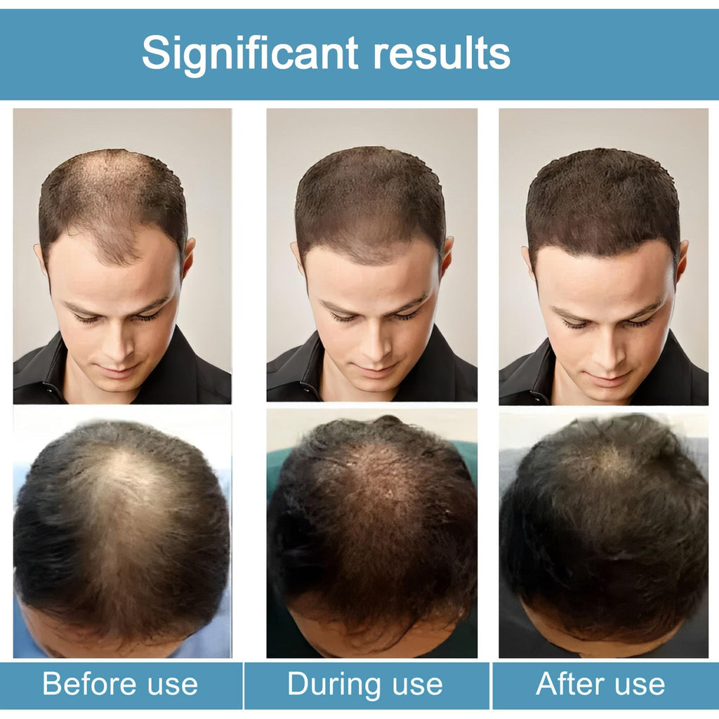 Hair Regrowth System | ANEFOSE — Ginseng, Eclipta Prostrata, Peppermint Oil & Ginger Root for Thicker Hair