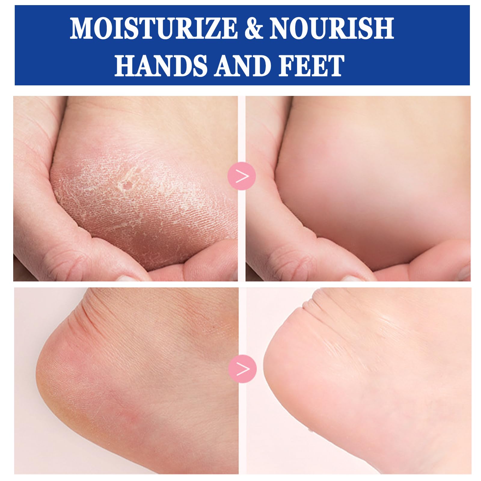 Anweina 2-Pack 60% Urea Foot Cream with 2% Salicylic Acid – Hydrating, Exfoliating, Anti-Cracking