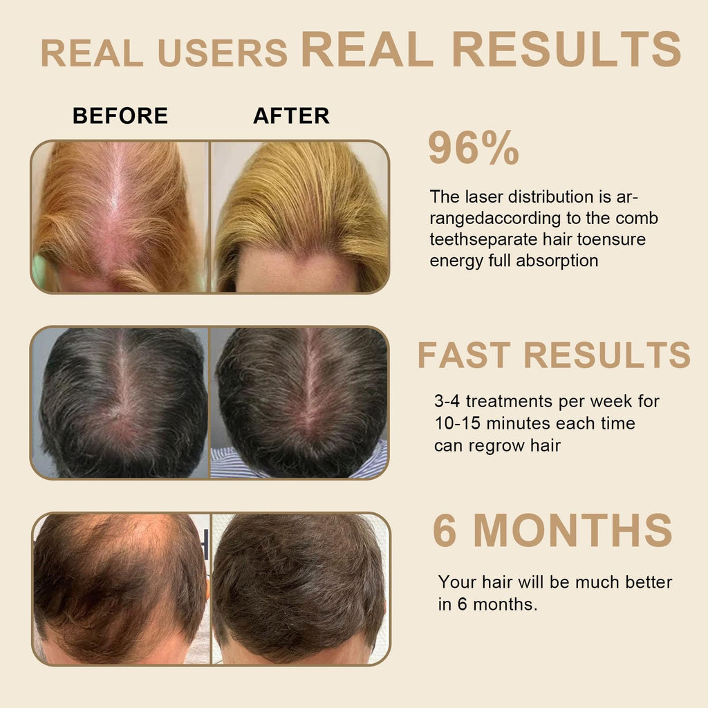 Apbier Laser Hair Growth Comb – At-Home Laser Therapy for Hair Growth