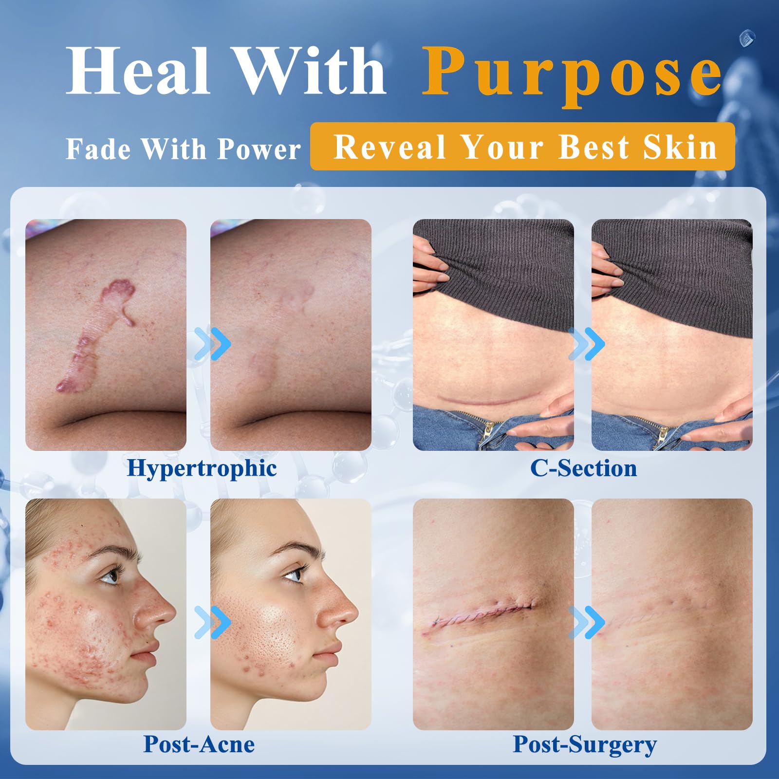 Arme Physician Formulated 52% Silicone Scar Gel | Scar Treatment for Surgical Scars