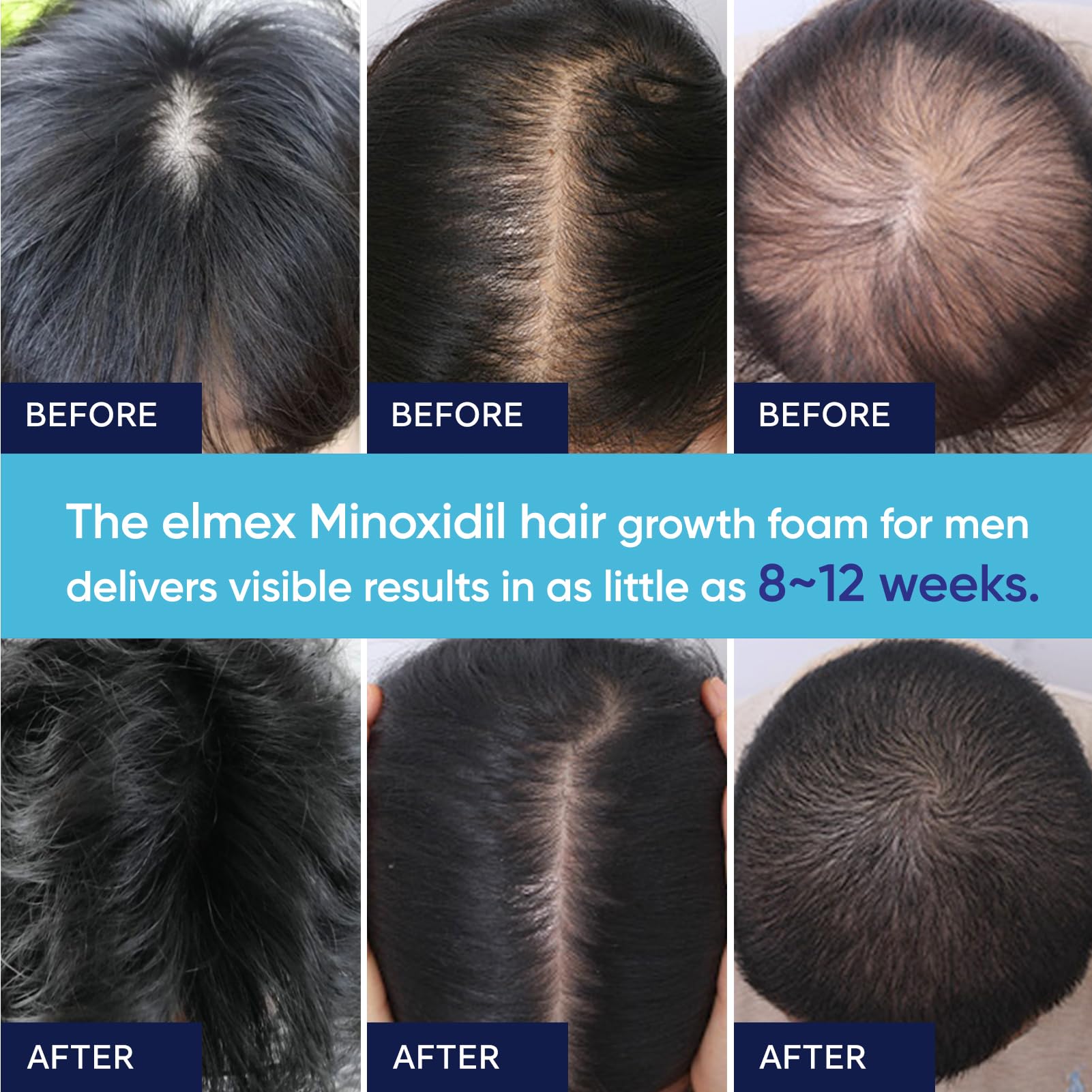 Artimore 5% Minoxidil Foam for Men and Women – Hair Growth Support (4 oz)