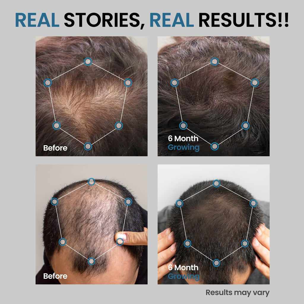 AVITAPURE 5% Minoxidil for Men — Extra-Strength Hair Growth Spray