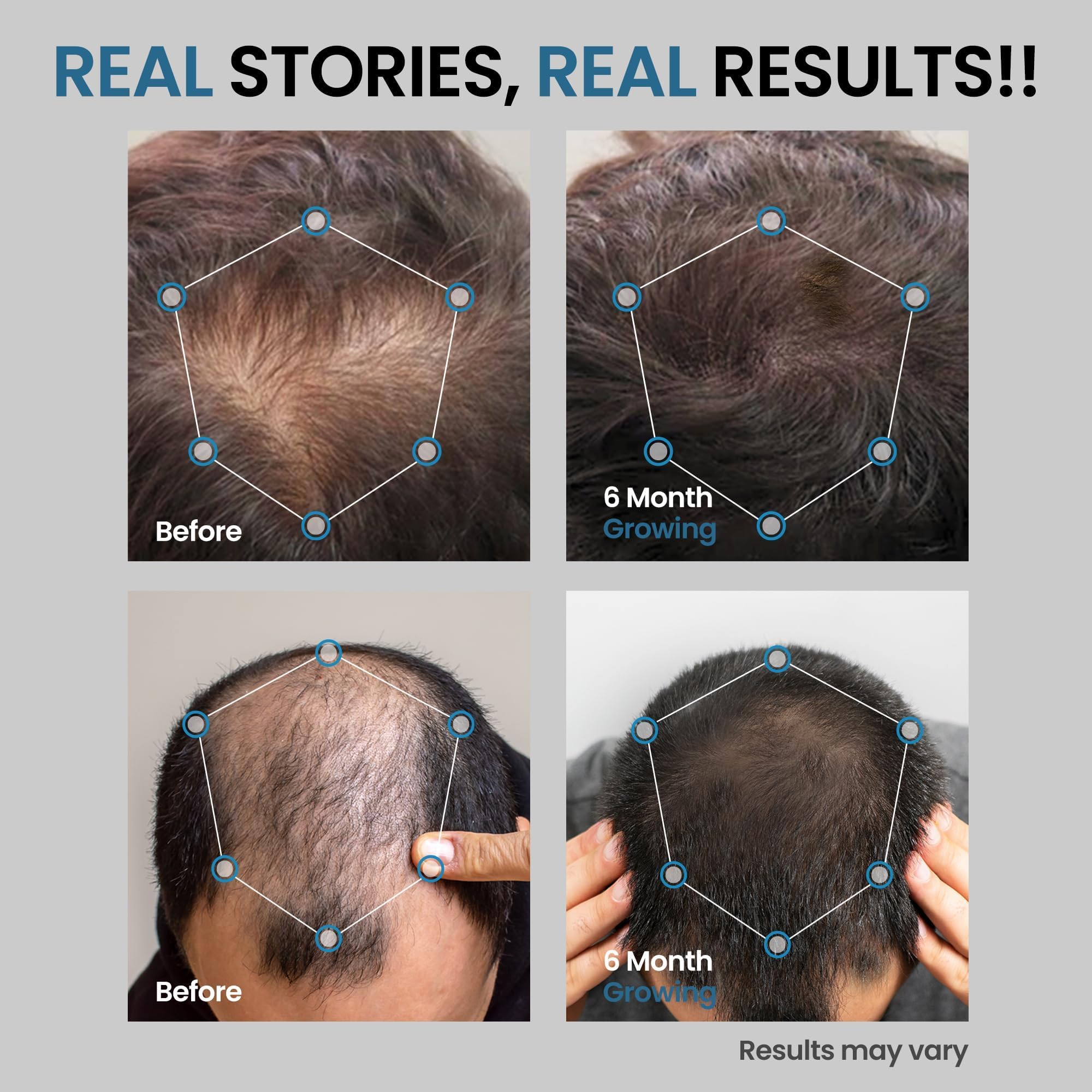 AVITAPURE 5% Minoxidil for Men — Extra-Strength Hair Growth Spray