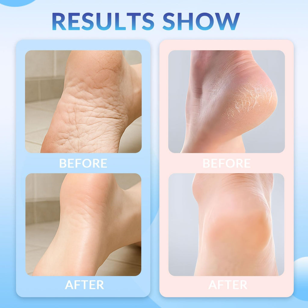 Awjsde Crack Feet Prevention Stick – Foot Care Cream for Dry, Cracked Heels (Blue + Pink)