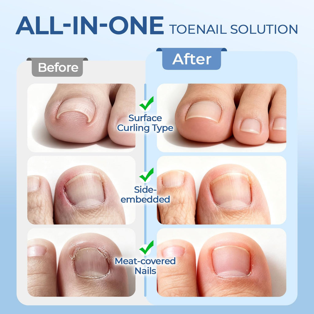 awrose Ingrown Toenail Corrector Set with Correction Strips | At-Home Pedicure Kit for Men & Women