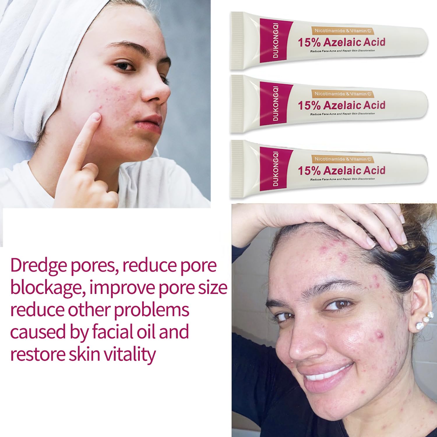 Azelaic Acid Serum for Face – Balance Skin Tone & Purify Pores, Acne Relief, Premium Skin Care, 20g
