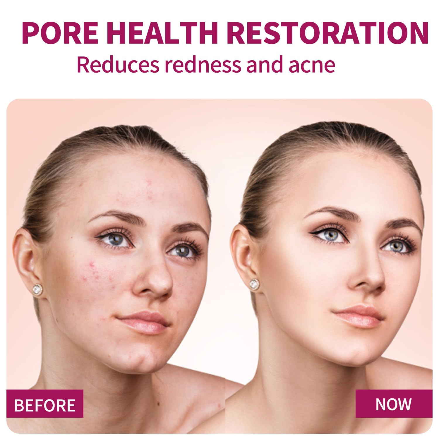 Azelaic Acid Serum for Face – Balance Skin Tone & Purify Pores, Acne Relief, Premium Skin Care, 20g