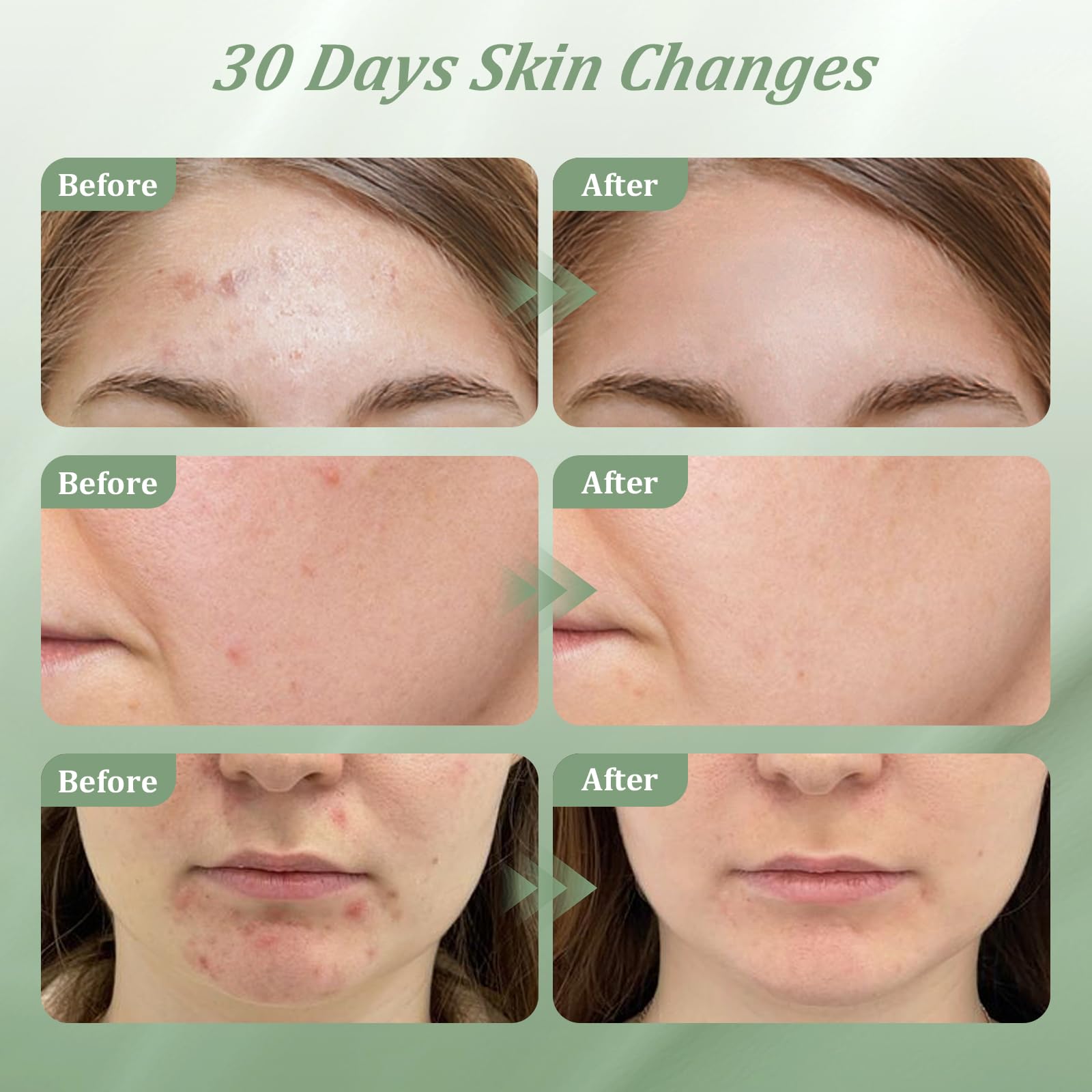 Bablabear 2% Salicylic Acid Acne Cream – Face, Back & Body (30g)