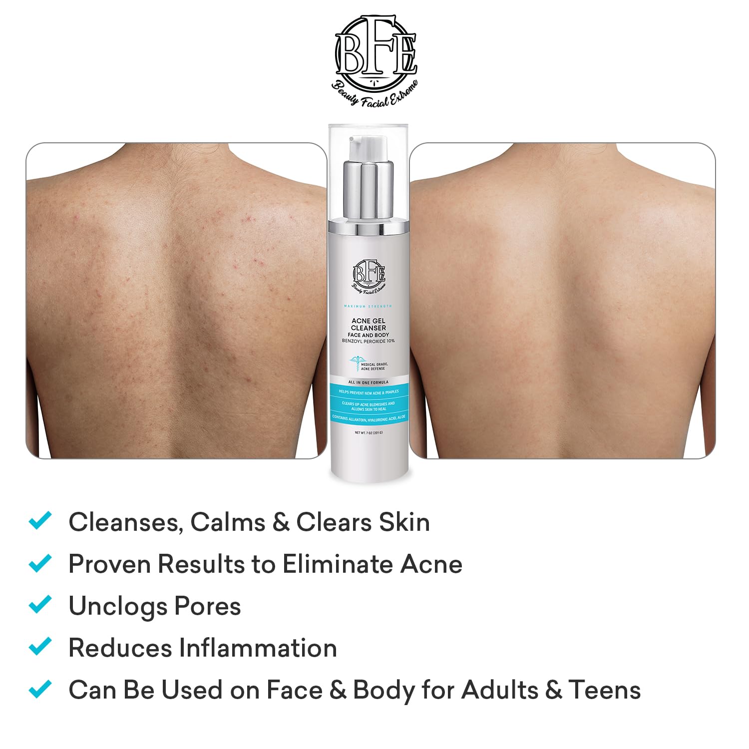 Beauty Facial Extreme Acne Face Wash 10% Benzoyl Peroxide – Deep Cleansing for Oily Skin & Breakouts