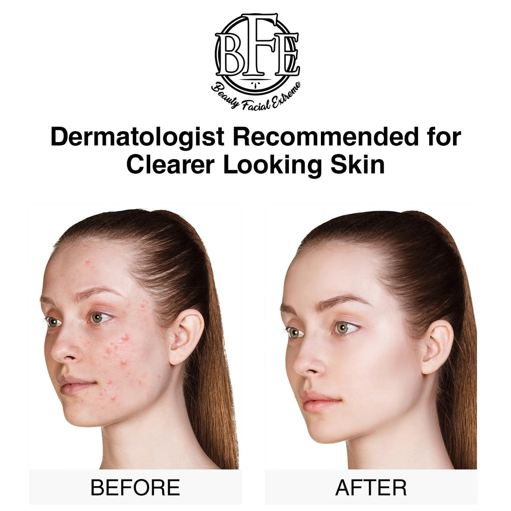 Beauty Facial Extreme Acne Treatment Pads – Clear Pimples, Oily Skin & Pores
