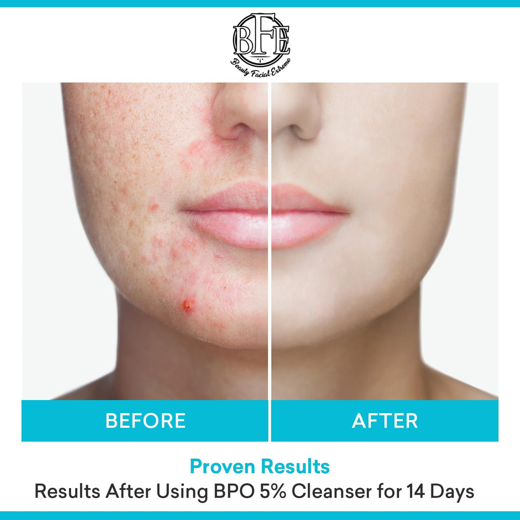 Beauty Facial Extreme Acne Wash 10% Benzoyl Peroxide – Clear Skin for Oily, Acne-Prone Skin