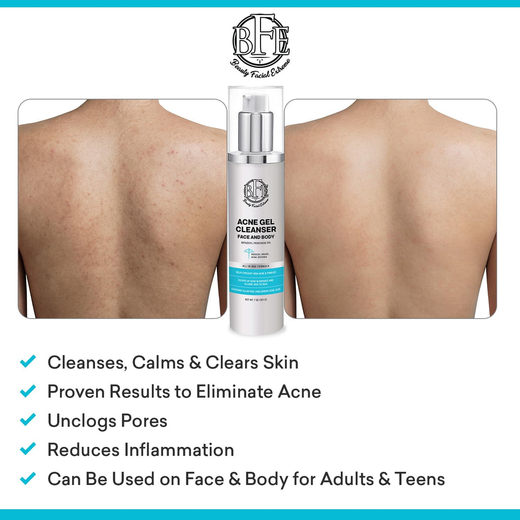 Beauty Facial Extreme Acne Wash 10% Benzoyl Peroxide – Clear Skin for Oily, Acne-Prone Skin