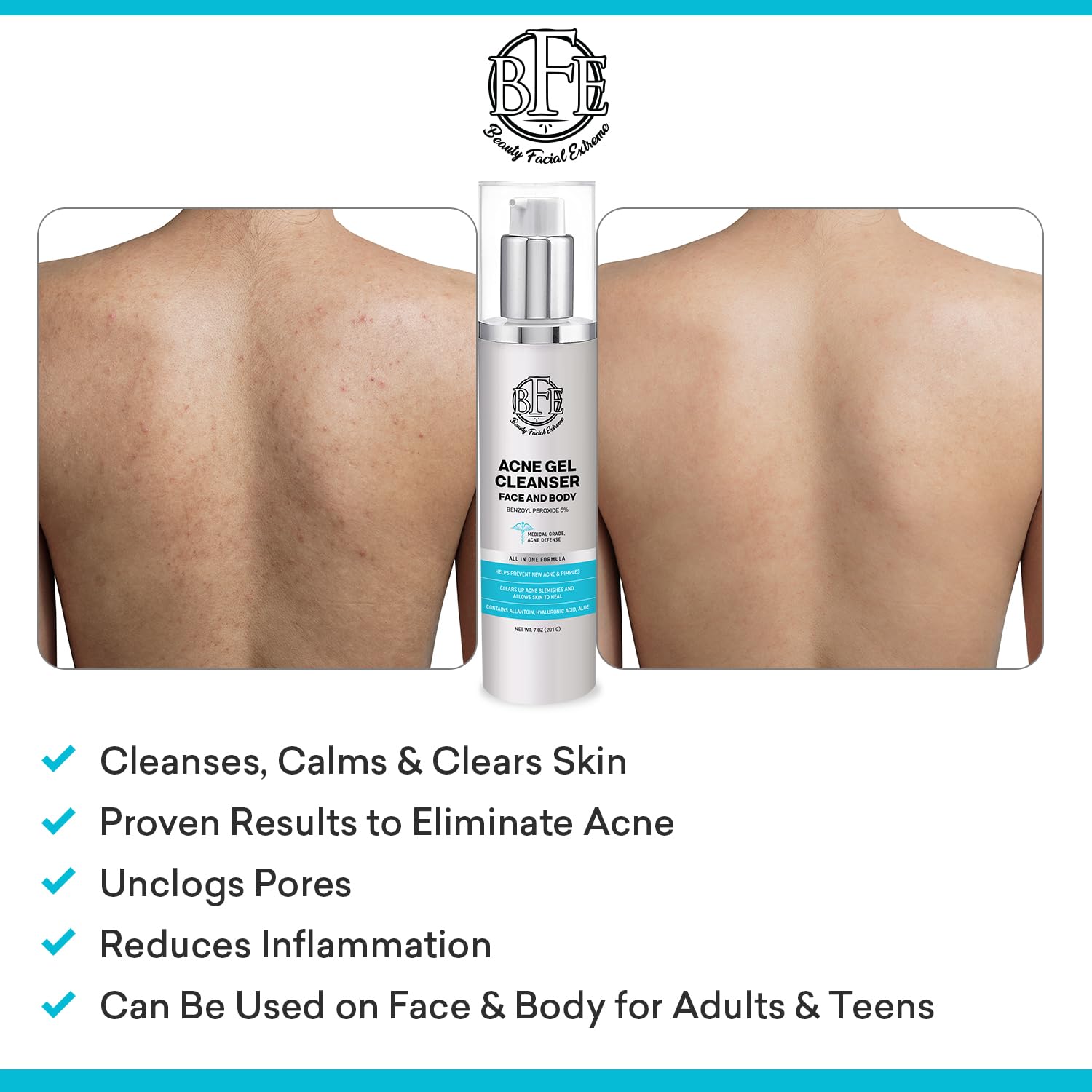 Beauty Facial Extreme Acne Wash 10% Benzoyl Peroxide – Clear Skin for Oily, Acne-Prone Skin