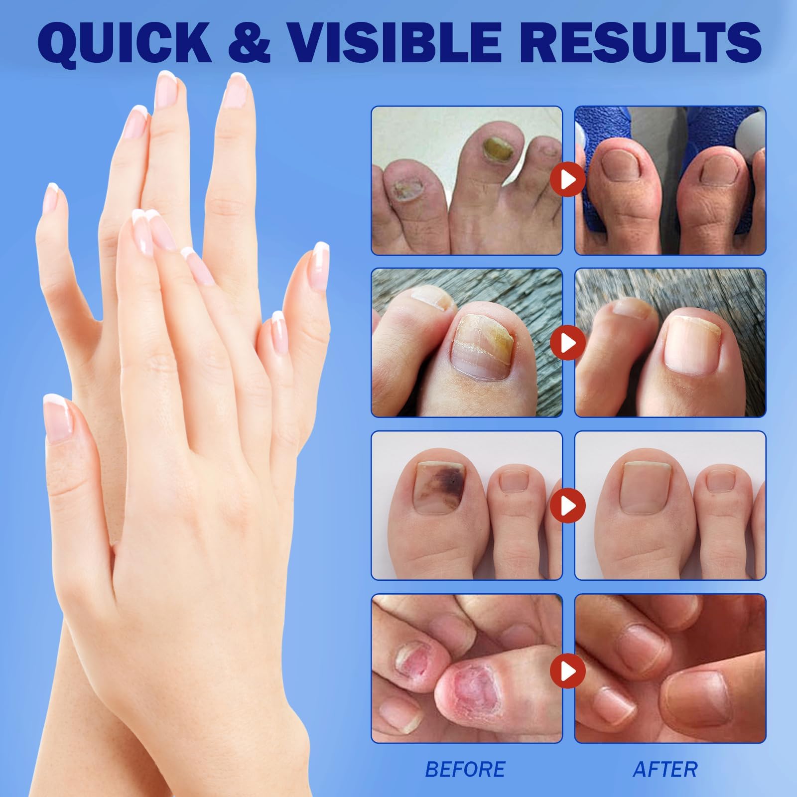 BFGCKJ Fungal Nail Patches for Toenails – 21-Count, Overnight Renewal