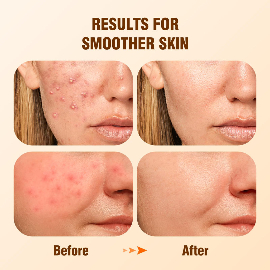 BIYSBER Salicylic Acid 2% Serum – Acne-Prone Skin, Oil Control & Hydration