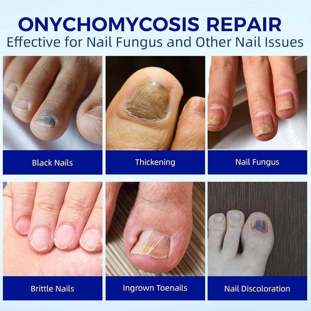 BOELIKAYS Fungal Nail Patches - Extra Strength Toenail Treatment (2pcs, Odorless)