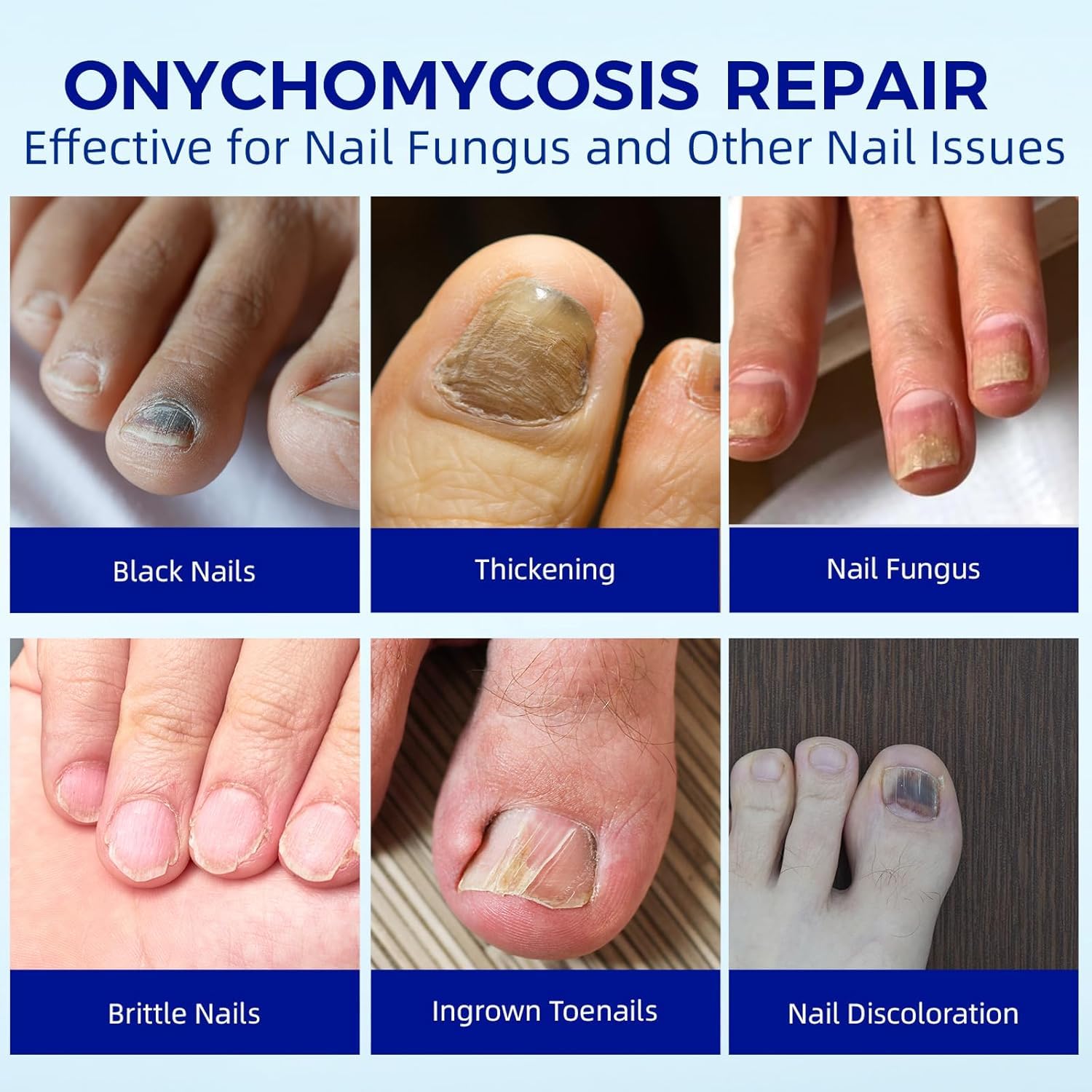 BOELIKAYS Fungal Nail Patches - Extra Strength Toenail Treatment