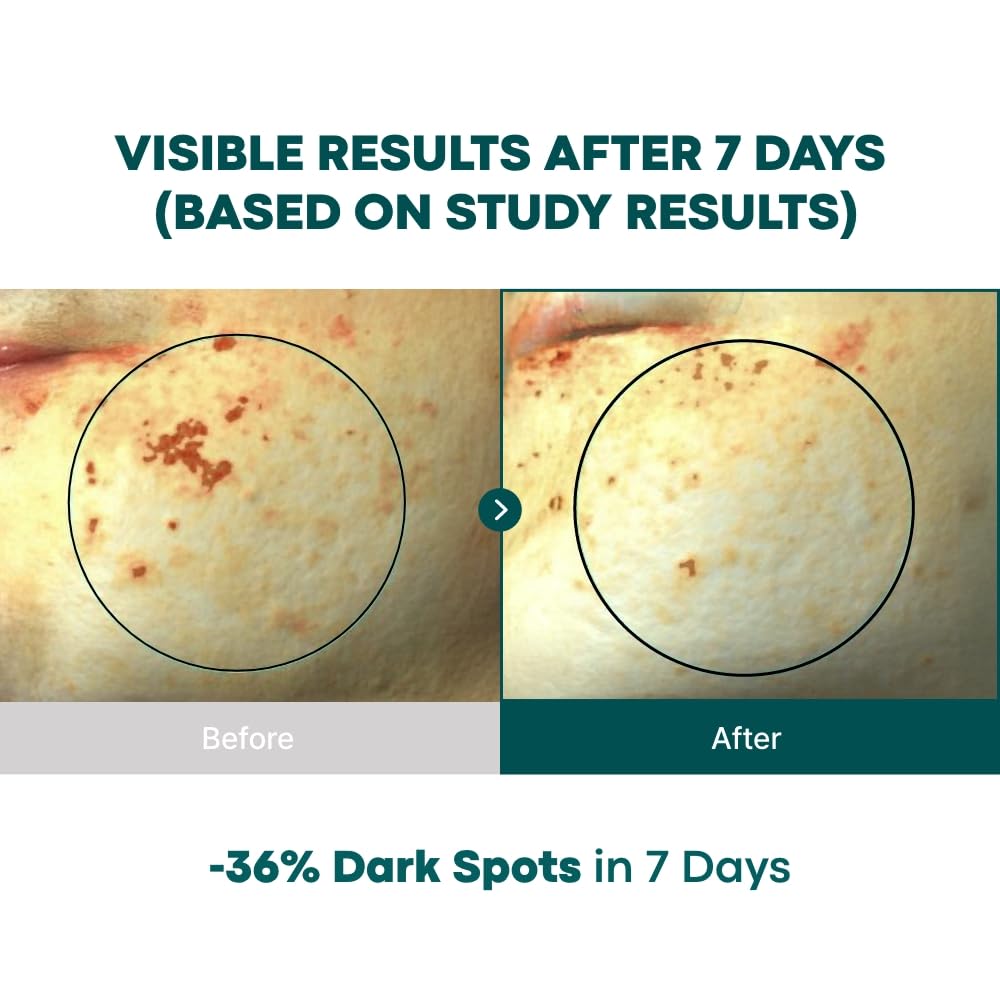 BONCEPT Vita C Capsule Double Shot Ampoule Kit – Korean Serum for Dark Spots & Even Skin Tone