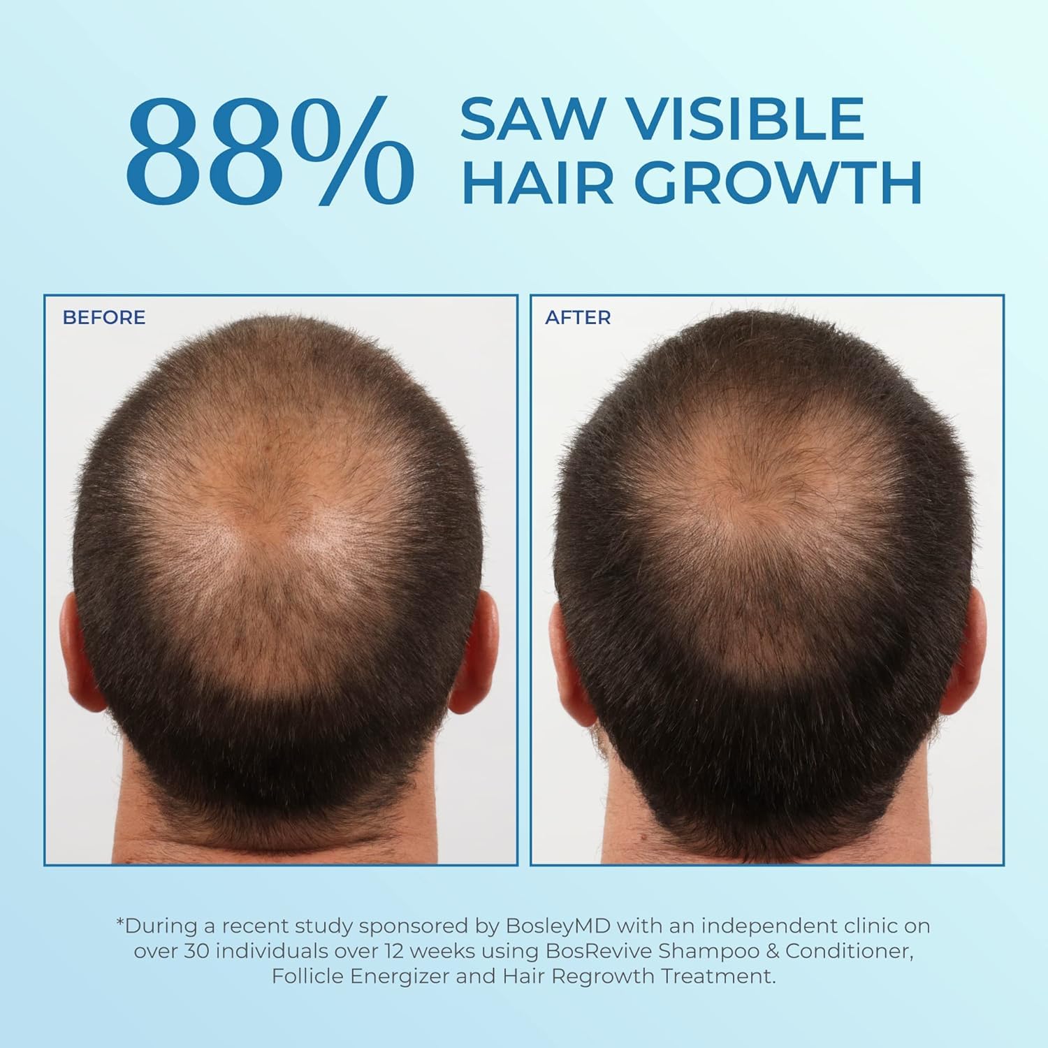 BosleyMD Minoxidil Spray Extra Strength for Men – 2-Pack, 60-Day Hair Regrowth Treatment