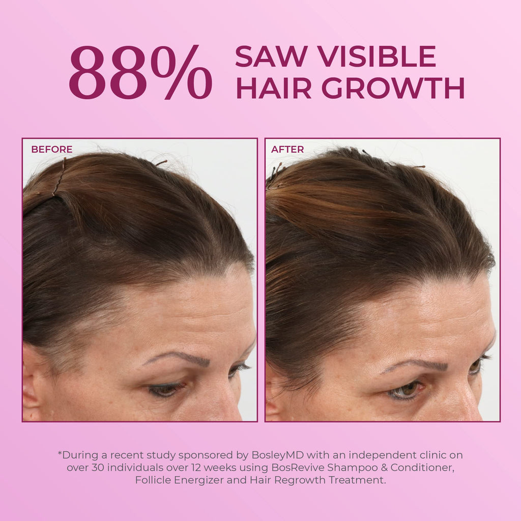BosleyMD Hair Regrowth Treatment Regular Strength for Women – 2 x 2 Oz (2 Count)