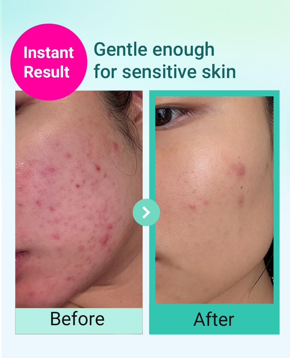 BRING GREEN Tea Tree Cica Trial Kit — Travel-Size Korean Skincare for Acne-Prone Skin