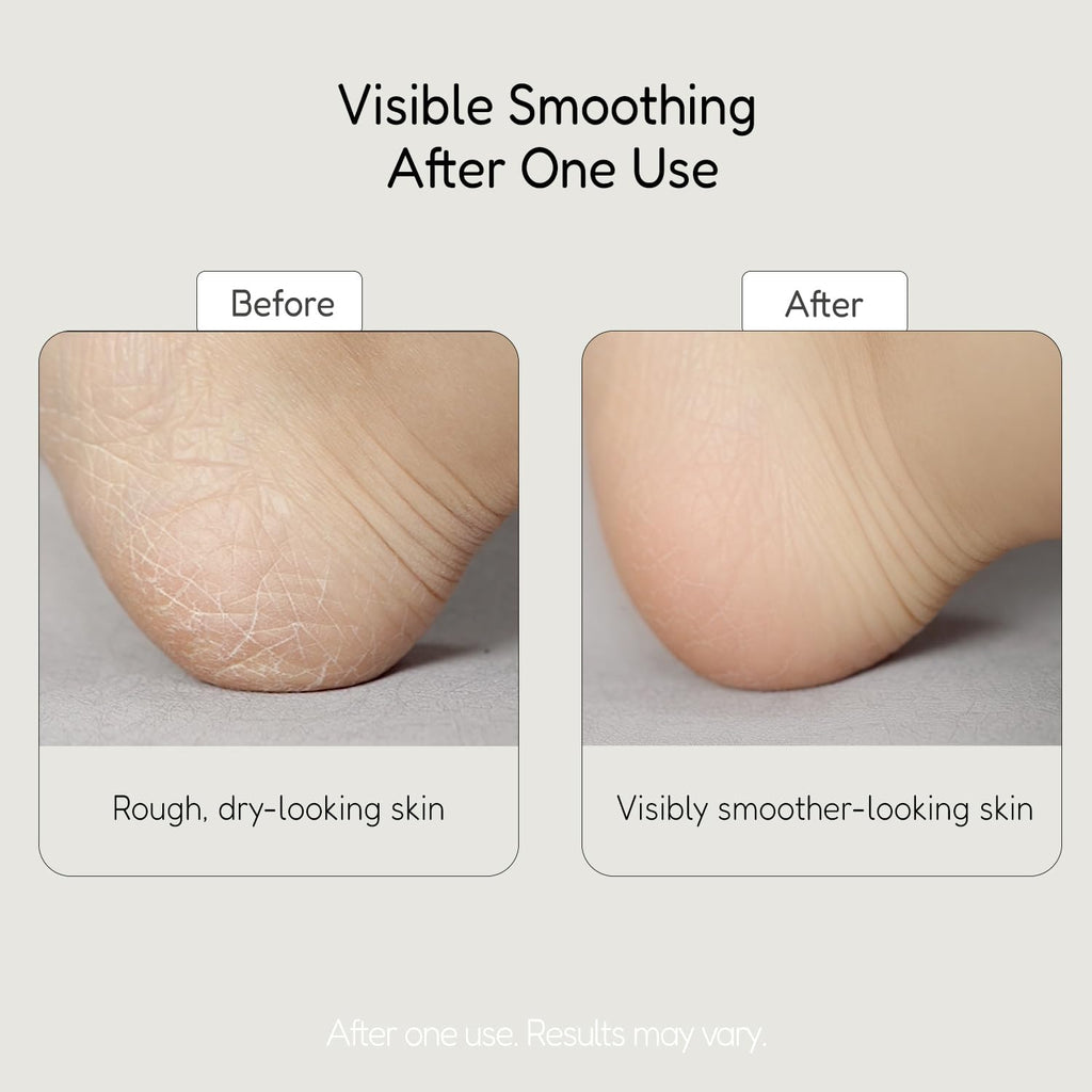 BUFFOUT Callus Eraser Exfoliating Gel – Feet, Heels, Elbows & Knees