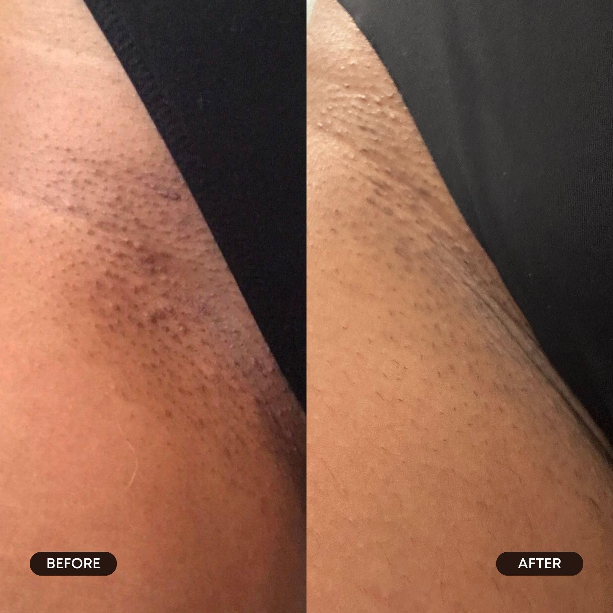 Bushbalm Exfoliating Ingrown Hair Pads – BHA & AHA for Underarm & Bikini Areas | Daily Use