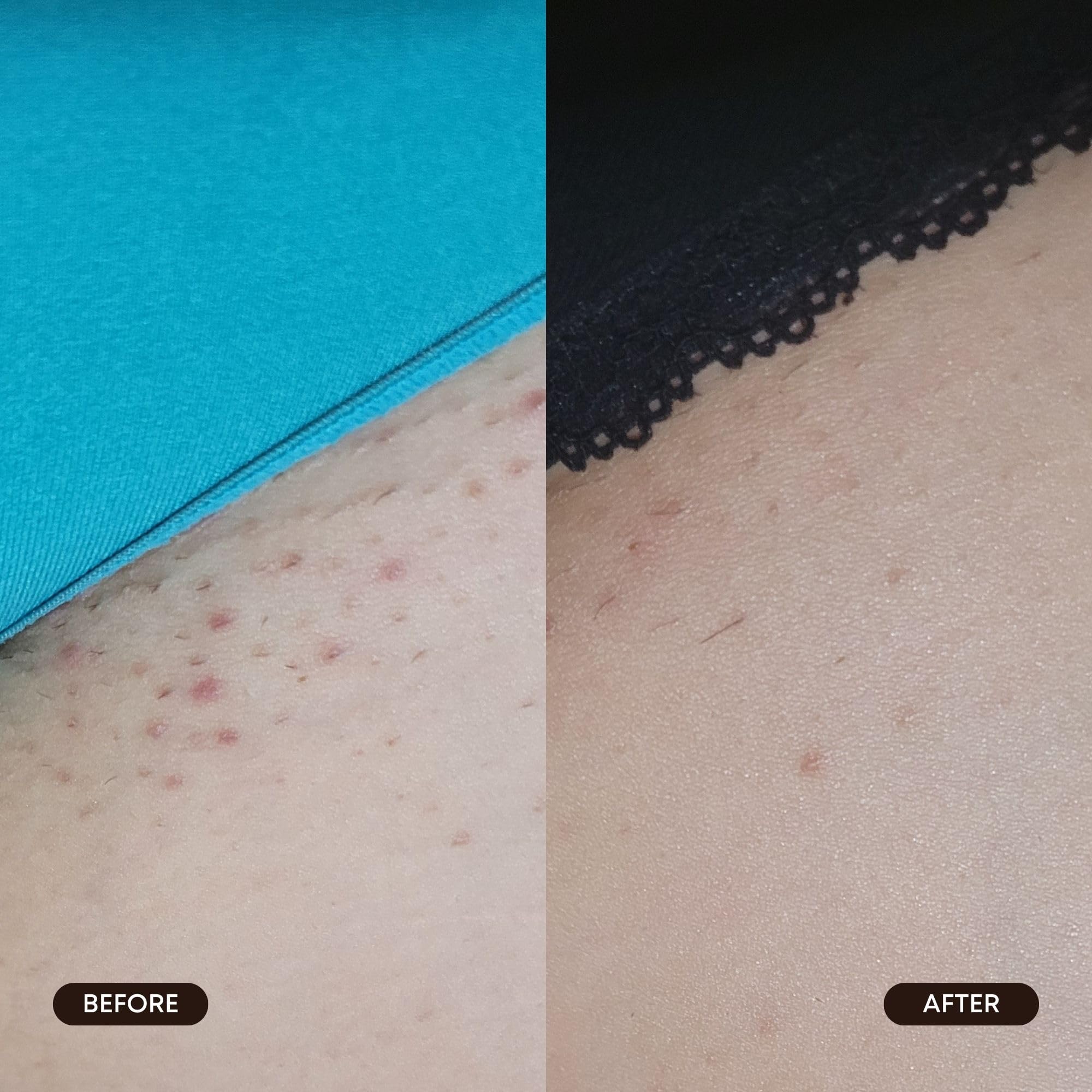 Bushbalm Exfoliating Ingrown Hair Pads – BHA & AHA for Underarm & Bikini Areas | Daily Use